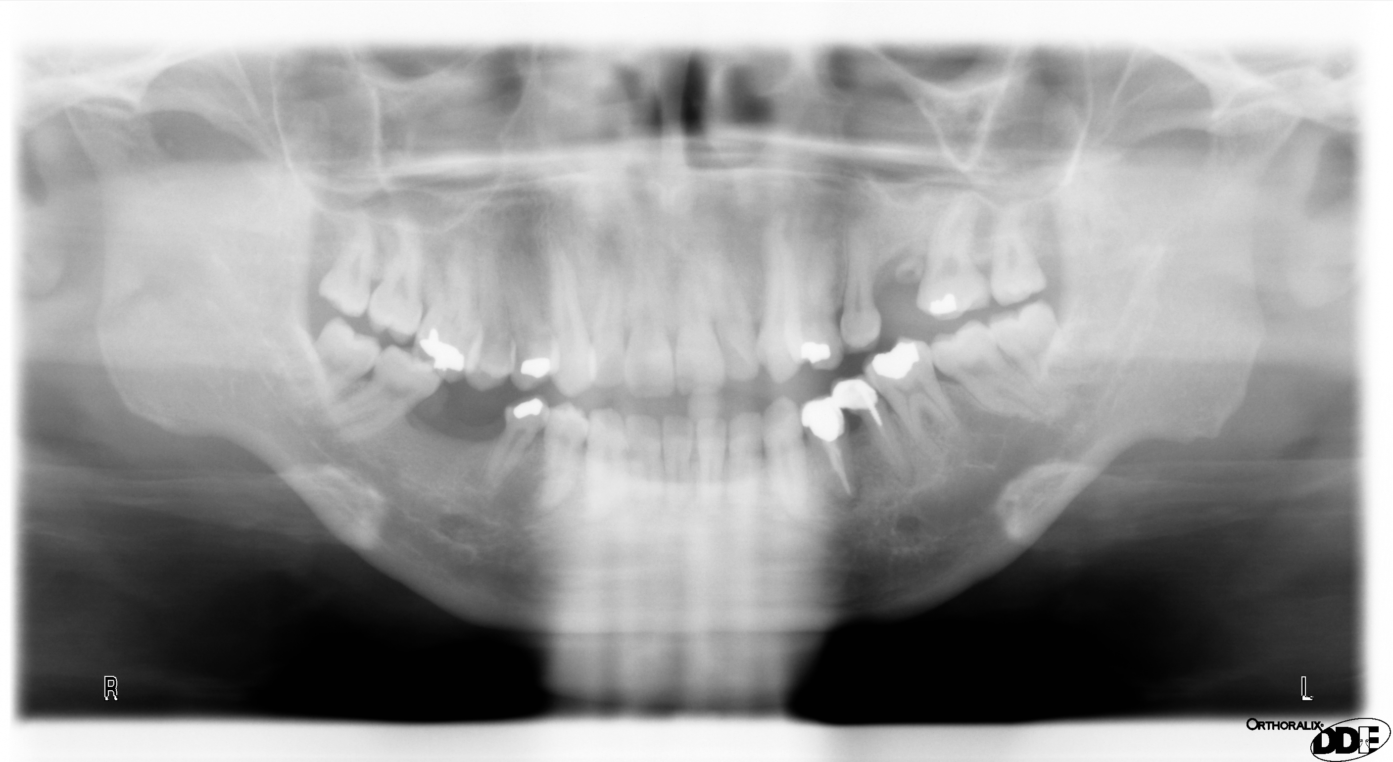 Con l'osteoporosi è possibile mettere un impianto?